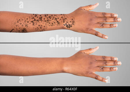 Laser Tattoo Removal On Woman's Hand Stock Photo