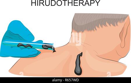 vector illustration of setting leeches on the man's back Stock Vector