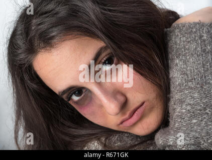 Attractive woman with a bruised black eye Stock Photo