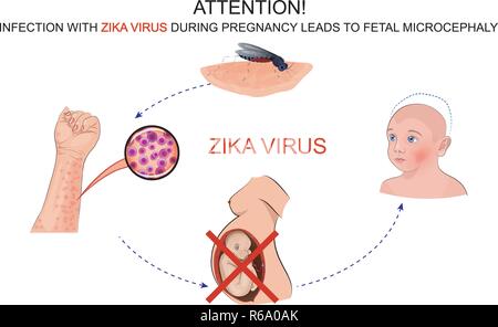 illustration of the effects of infection by zika virus for pregnant women Stock Vector