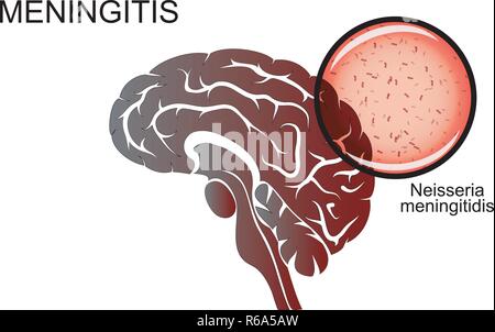 illustration of the brain, meningitis, the causative agent of meningitis. neuroscience Stock Vector