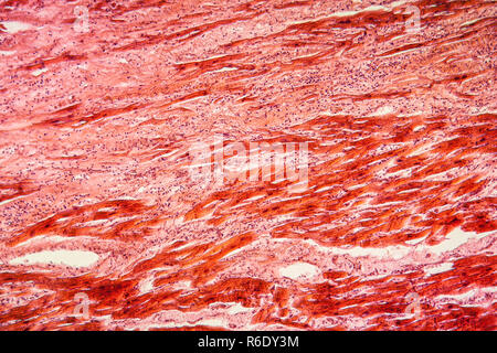 cyst of the ovary diseased tissue 100x Stock Photo
