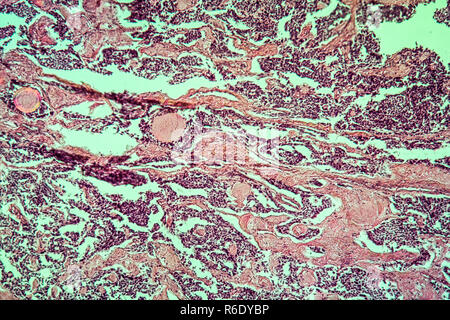 thyroid scirrhous carcinoma diseased tissue 100x Stock Photo