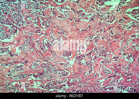 thyroid scirrhous carcinoma diseased tissue 100x Stock Photo