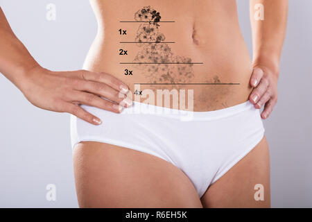 Laser Tattoo Removal On Woman's Stomach Stock Photo