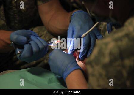 U.S. Army Maj. Aaron Taff and Staff Sgt. Angela Byrd with the Wyoming National Guard Medical Detachment, extract a patient's tooth at a medical readiness event during Beyond the Horizon 2017, in San Ignacio, Belize, May 14, 2017. BTH 2017 is a U.S. Southern Command-sponsored, Army South-led exercise designed to provide humanitarian and engineering services to communities in need, demonstrating U.S. support for Belize. Stock Photo