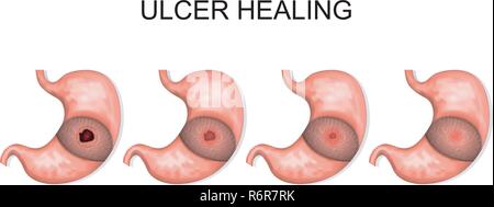 an illustration of the process of ulcer healing Stock Vector