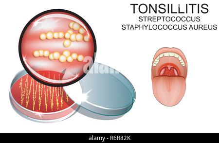 illustration of sore throat. strep. the causative agent of the infection. bacterial seeding.  Stock Vector