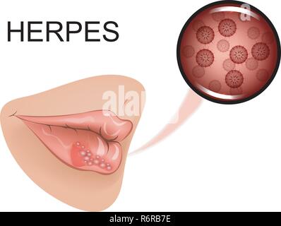 vector illustration of infection on female lips Stock Vector