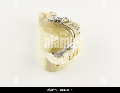 steel base of the clasp prosthesis on the gypsum model Stock Photo