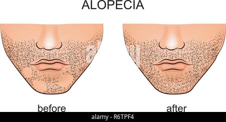 illustration of alopecia areata on the male chin Stock Vector