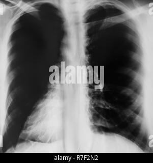 lung radiography, or x-ray film lung examination Stock Photo