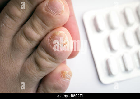 Close up of nail fungus infection on toe finger Stock Photo