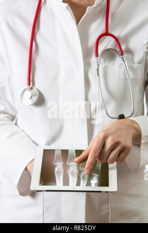 Female doctor holding a tablet computer, iPad, with an X-ray of finger joints Stock Photo