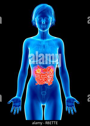 Illustration of small intestine cancer. Stock Photo