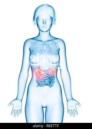 Illustration of small intestine cancer. Stock Photo