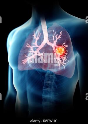 Illustration of a man's lung tumour. Stock Photo