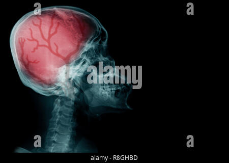 x-ray image with red hight light with blood supply in brain Stock Photo