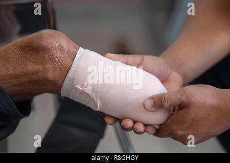 below knee amputation patient with elastic bandaging to prepare for leg prosthesis Stock Photo