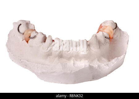 plaster cast of teeth with removable partial denture isolated on white background Stock Photo