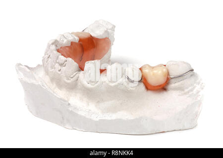 plaster cast of teeth with removable partial denture isolated on white background Stock Photo