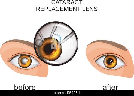 vector illustration of a replacement of the crystalline lens in cataract Stock Vector