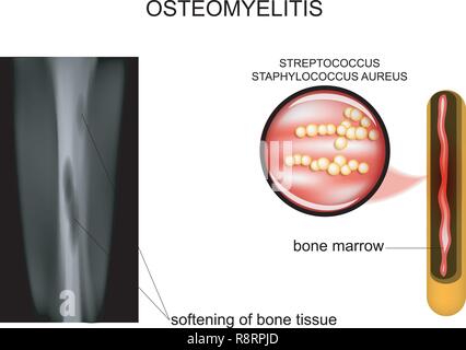 vector illustration of bone lesions osteomyelitis Stock Vector