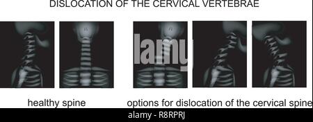 Dislocation of the Cervical Spine