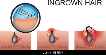 Ingrown Hair Stock Photo 64490729 Alamy
