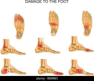 illustration of joint injuries and pain. vectors Stock Vector Image ...