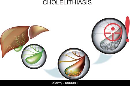 illustration of gallstone disease. pain and symptoms Stock Vector