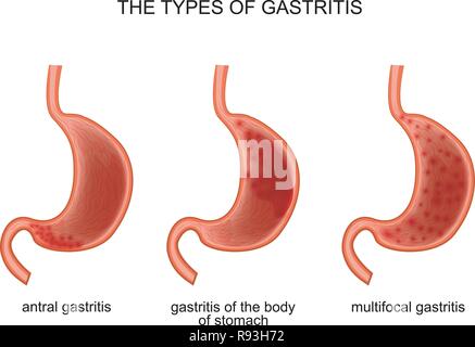 vector illustration of the types hypertrophic gastritis Stock Vector ...