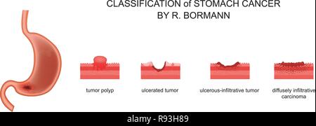 vector illustration of classification of gastric cancer Stock Vector