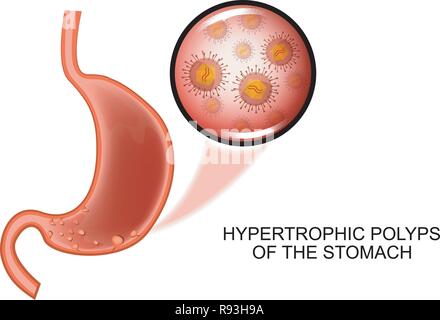 vector illustration of hypertrophic polyposis of the stomach Stock Vector