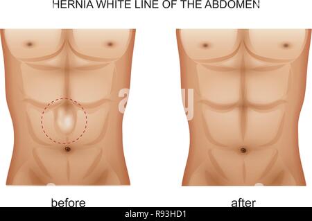 vector illustration of a hernia white line of the abdomen Stock Vector