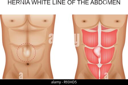 vector illustration of a hernia white line of the abdomen 2 Stock Vector