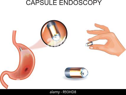 vector illustration of capsule endoscopy. EGD, gastroenterology. Stock Vector