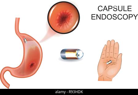 vector illustration of capsule endoscopy. EGD, gastroenterology 2 Stock Vector