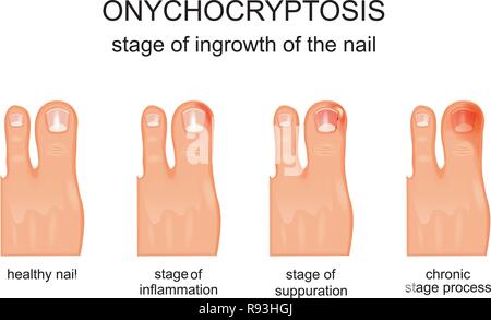 INGROWN NAIL Stock Photo: 184709806 - Alamy