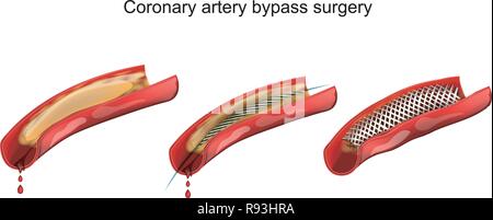 vector illustration of coronary artery bypass grafting Stock Vector ...