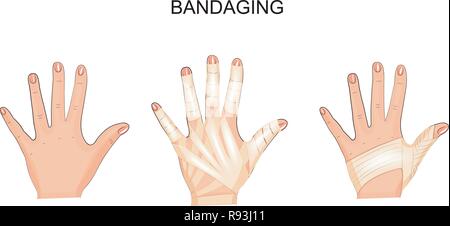 vector illustration of bandaging his hands. surgery Stock Vector