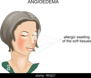 vector illustration of angioedema. allergic swelling of the soft tissues of the face Stock Vector