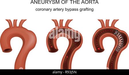 vector illustration of coronary artery bypass vessels Stock Vector ...