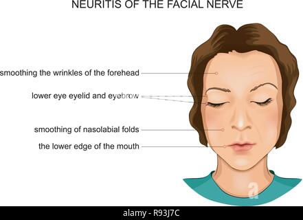 vector illustration of facial nerve neuritis in a child Stock Vector ...