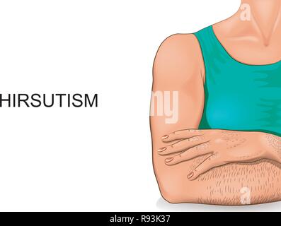 vector illustration of the body of women suffering from hirsutism Stock Vector