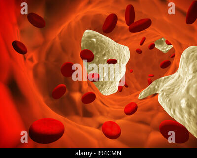 Atherosclerosis - clogged artery and erythrocytes Stock Photo