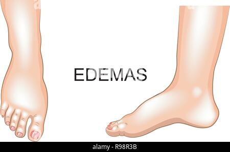 vector illustration of edema on feet. swelling Stock Vector