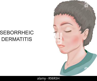 vector illustration of seborrheic dermatitis of the skin Stock Vector