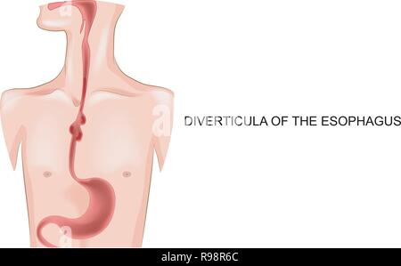 vector illustration of diverticula of the esophagus Stock Vector