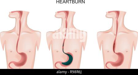 vector illustration of an esophagus suffering from heartburn Stock Vector